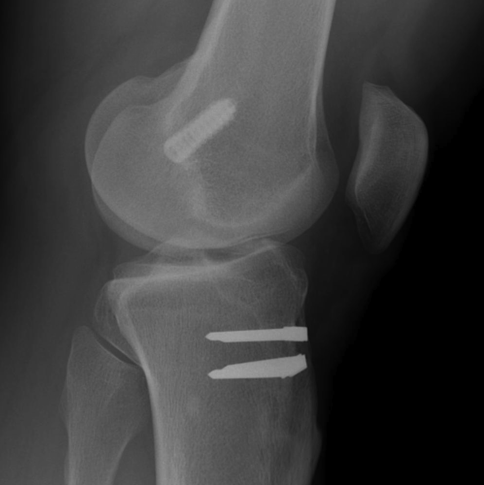 ACL Graft Rupture Femoral Tunnel Anterior